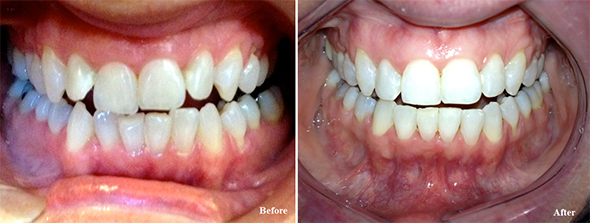 Six Month Smiles® Makeover