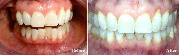 Six Month Smiles® Makeover