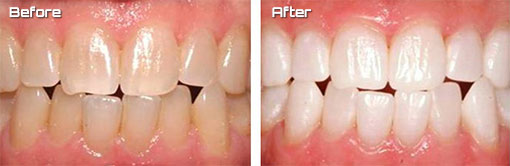 Dental Whitening