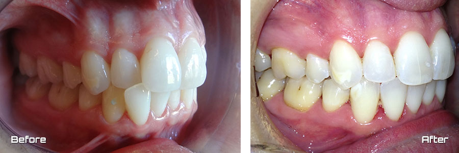 Invisalign®