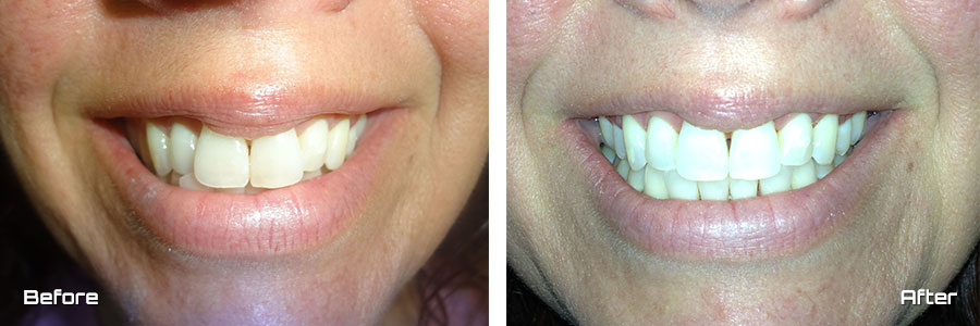 Invisalign®