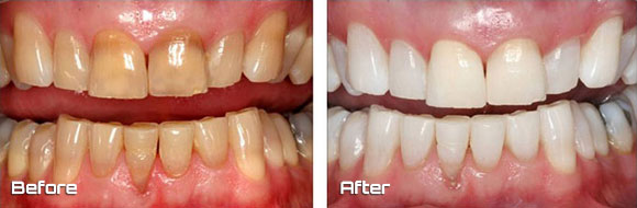 kor whitening