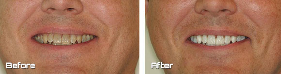 kor whitening
