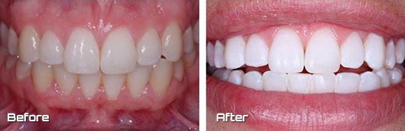 kor whitening