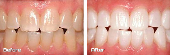 kor whitening