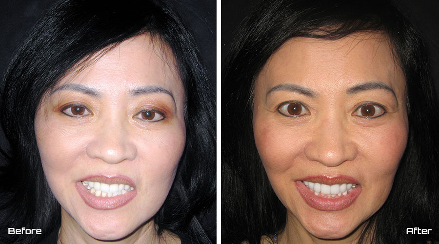 Veneers