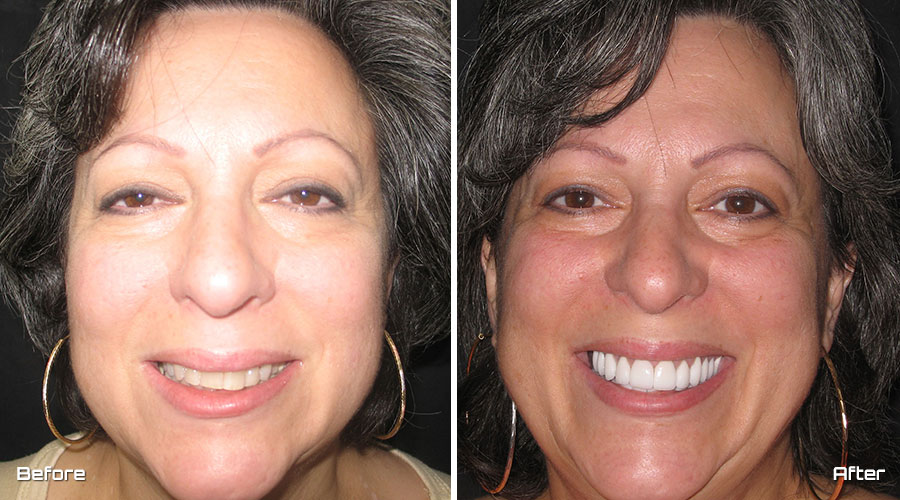 Veneers